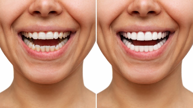 Smile before and after dental makeover in Antioch, IL
