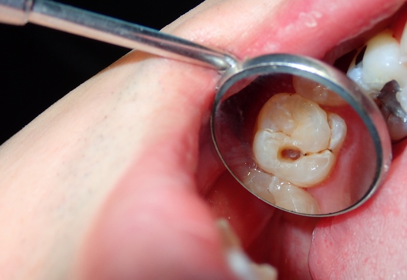 Close-up of a dental checkup in Antioch, IL showing a tooth with a cavity