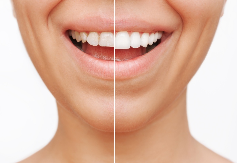 Before and after dental treatment image in Antioch, IL
