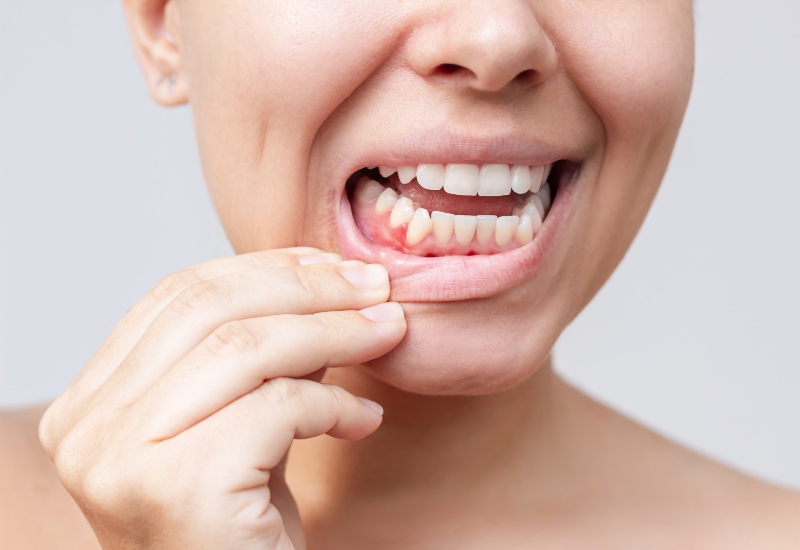 Close-up of a person showing lower gum and teeth in Antioch, IL